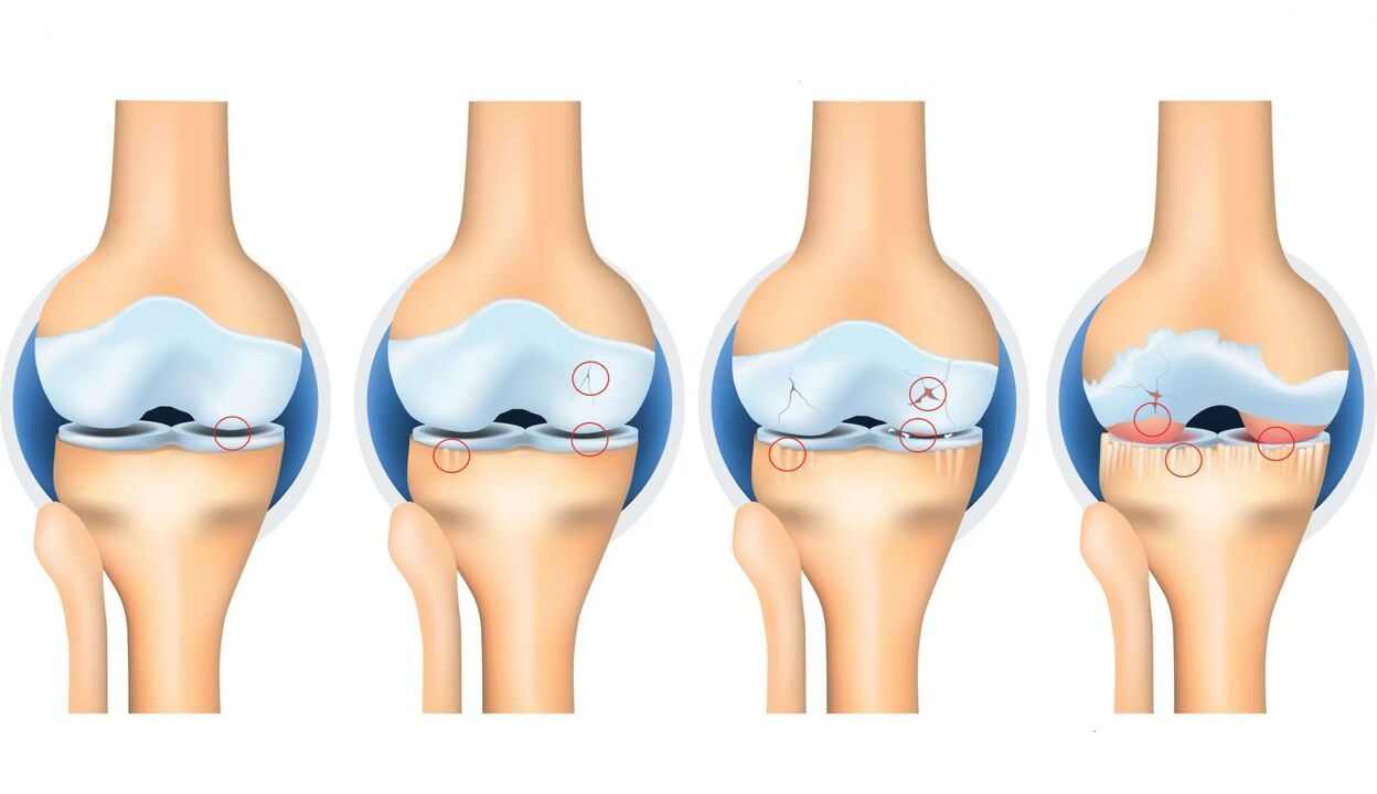 Osteoartritis de las articulaciones. 